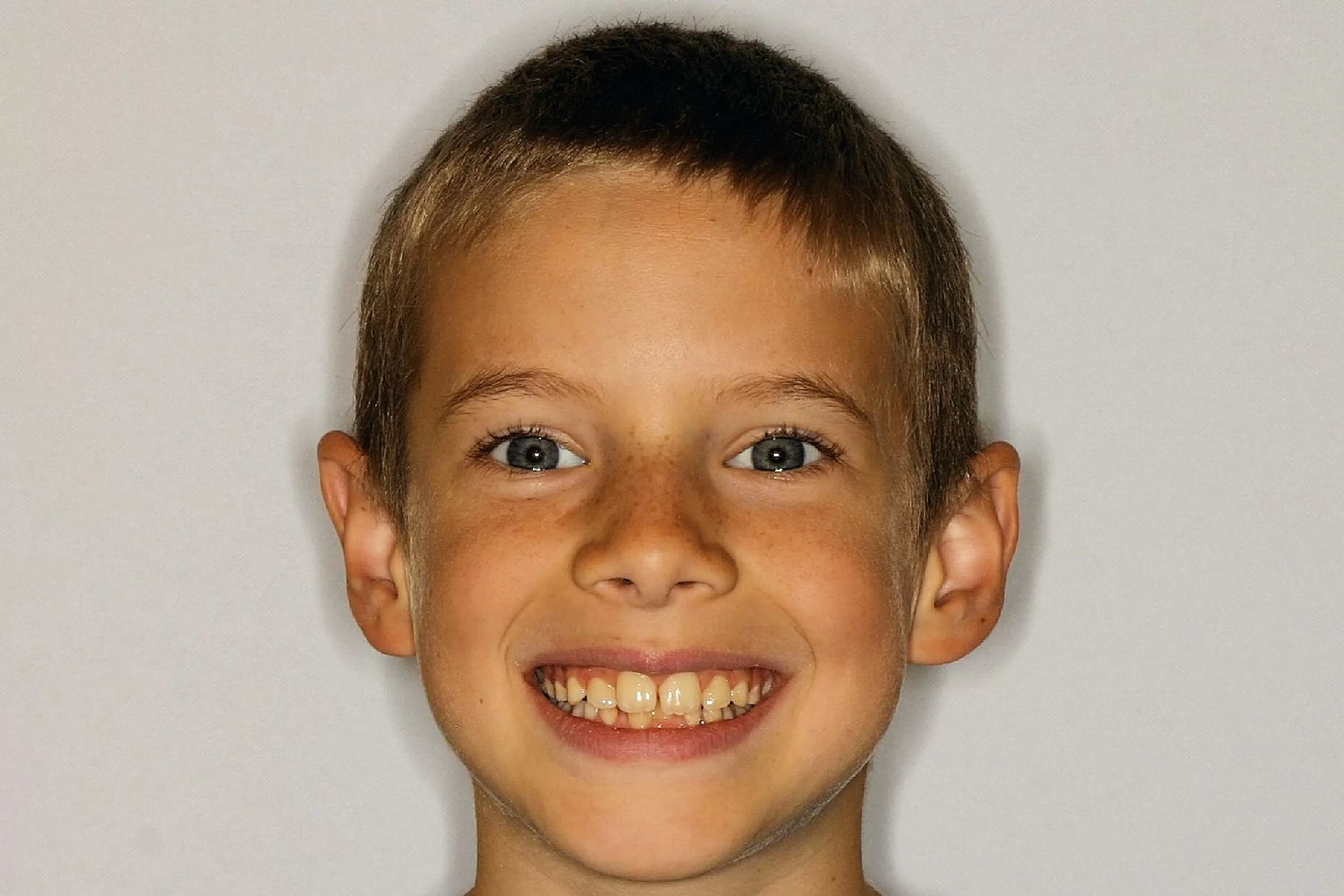 orthodontic dental before and after