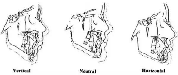 graphic for What is Anterior Vertical Growth?