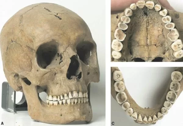graphic for Is there a Difference Between Human Jaws Now and Human Jaws in Ancient Times?