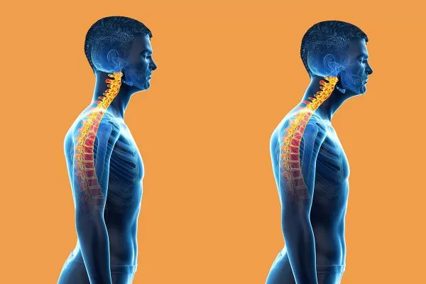 graphic for What does Forward Head Posture Look Like?