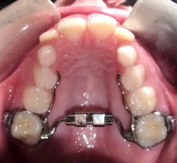 graphic for Why are Braces Alone Insufficient for Teeth Correction?