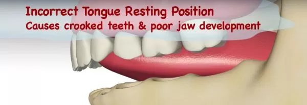 graphic for Orthodontic Relapse and the Tongue